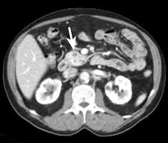 We did not find results for: Pancreatic Cancer Management Demands Teamwork Multidisciplinary Approach