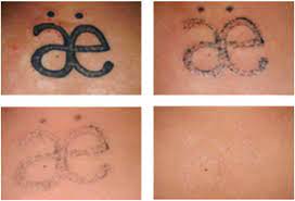 Maybe you would like to learn more about one of these? Tattoo Removal San Antonio San Antonio Med Spa