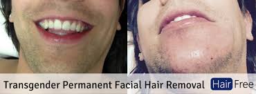 During electrolysis hair removal treatment a thin needle gets inserted. Transgender Permanent Facial Hair Removal The Ultimate Guide