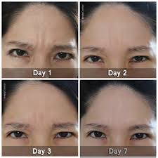 Botox pictures day by day. Botox Review At Cutis Medical Laser Clinics 208 To Get Rid Of Forehead Wrinkles Mybeautycravings