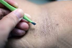 Underarm hair can cause unpleasant odors, despite daily hygiene. Is It Possible To Permanently Remove Armpit Hair Quora