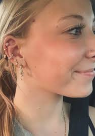 Fractured Radial Head Recovery and Support