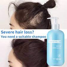 However, advanced hair thinning and hair loss affects millions of people throughout the western world. Ready Stock Amino Acid Hair Loss Shampoo Hair Loss Oil Control Nourish Hair Hair Care Anti Hair Loss Shampoo 30 Shopee Malaysia