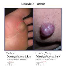Image result for Nodule