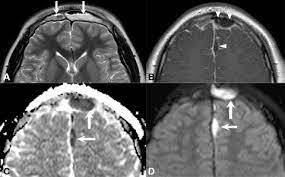 Paranasal Sinus Disease An Overview Sciencedirect Topics