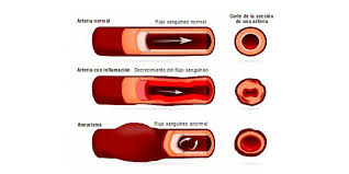 La causa es multifactorial, pero la aterosclerosis a menudo está involucrada. Aneurisma De Aorta Sintomas Prevencion Y Tratamiento
