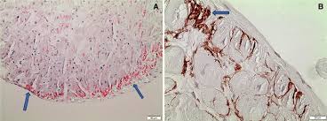 Emb with congo red staining of amyloid deposits has long been the gold standard for establishing the diagnosis of cardiac amyloidosis. Endomyocardial Biopsy Stained With Congo Red And Visualized In Download Scientific Diagram