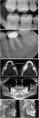La quasi totalité des images radiographiques à l'heure actuelle sont numérisées et certaines sont tirées sur support argentique, d'autres sont tout simplement imprimées sur papier. Radiografie Dentara