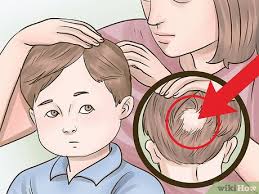 Even though there are no baby hair loss remedies around that would prevent the problem altogether, its effects can be minimized by gently treating the scalp of your baby. How To Stop Hair Loss In Children With Pictures Wikihow