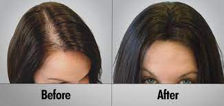 Hair Transplantation And Hair Thickness Cevre Health Center Thick Hair Remedies Hair Laser Growth Prp Hair Loss Treatment
