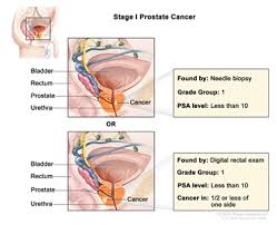 Again, bone is the most common site of where the cancerous cells from prostate to spread. Prostate Cancer Treatment Pdq Treatment Patient Information Nci Michigan Medicine