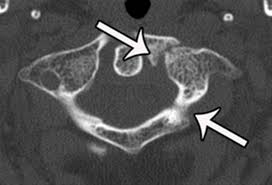 The maisonneuve fracture is a spiral fracture of the proximal third of the fibula associated with a tear of the distal tibiofibular syndesmosis and the interosseous membrane. Atlas Fractures Transverse Ligament Injuries Spine Orthobullets