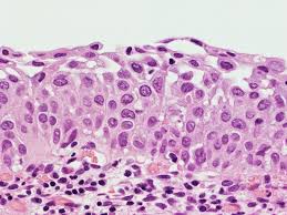 It corresponds to the area of cervix bound by the original squamocolumnar junction at the distal end and proximally by the furthest extent that squamous metaplasia has occurred as defined by the new squamocolumnar junction. Pathology Outlines Squamous Metaplasia