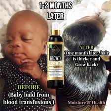 ORGANIC BABY/CHILDREN Hair Growth Leave In-detangling Conditioner Spray.  Cradle Cap, Baby Hair Growth, Scalp Eczema & Scalp Fungus