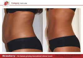 Before And After Inch Loss Non Invasive Laser Lipo Laser Liposuction Liposuction Laser Lipo