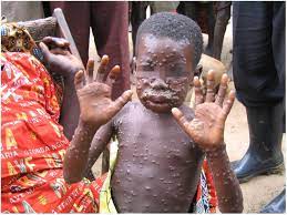 Monkeypox is a viral disease that causes symptoms such as fever, sweating, and a rash with papules and pustules on the face and chest. Major Increase In Human Monkeypox Incidence 30 Years After Smallpox Vaccination Campaigns Cease In The Democratic Republic Of Congo Pnas