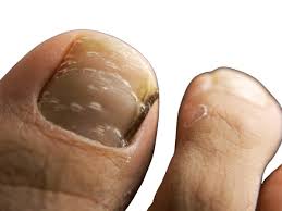 Image result for Beau lines feet