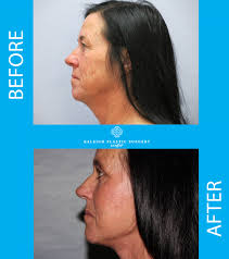 With Raleigh Plastic Surgery Centers neck lift procedure you can say  goodbye jowls and sagging skin. Our surgeons are able to transform and  redefine this patient's neck and jawline, giving her a more youthful shaped  face and tighter neck. This procedure ...