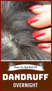 How To Get Rid Of Dandruff Overnight Hair Haircare Dandruff Dandruffremoval Diyhaircare H Hair Mask For Dandruff Hair Dandruff Home Remedies For Dandruff