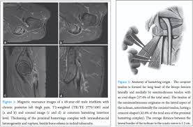 A New Technique For Surgical Treatment Of Proximal Hamstring Tendinopathy In A Triathlon Athlete Journal Of Orthopaedic Case Reports