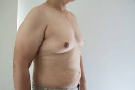 Image result for Gynecomastia
