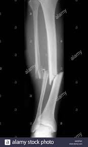 Any bone in our body can break or get fractured. Fracture Of Tibia And Fibula Stockfotos Und Bilder Kaufen Alamy