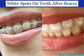 Depending on what type of braces you have, some methods may work better than others. White Spots On Teeth After Braces Causes How To Fix Orthodontic Braces Care