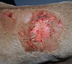Image result for Pyoderma Gangrenosum