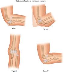 Image result for Galeazzi Sign