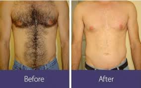 Full body laser hair removal process can cost you anywhere from $900 to $3000 on average. How Much Does Laser Hair Removal Cost Boston Laser Hair Removal Krauss Dermatology
