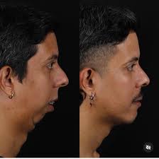 What did Kody do to his face?