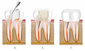 Our powerful toothpaste collection helps reverse early gum damage. Root Canal Treatment Crouch End 186 Park Road Dental Practice