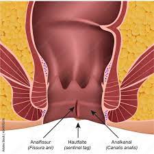Anal Fissur Illustration mit Erklärung deutsch latain Векторный объект  Stock | Adobe Stock