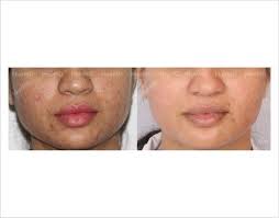 Benefits of laser hair removal: Upper Lip Laser Hair Removal Before And After Images Fue Hair Transplant Easy Hair Removal Laser Hair Removal Treatment