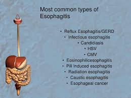 Formulary drug information for this topic. Esophagitis