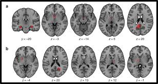 Image result for Brain Lesion