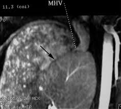 Catheter Directed Thrombolysis And Thrombectomy For The Budd Chiari Syndrome In Paroxysmal Nocturnal Hemoglobinuria In Three Patients Journal Of Vascular And Interventional Radiology