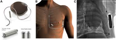Start studying pacemakers & icds. Acute And 3 Month Performance Of A Communicating Leadless Antitachycardia Pacemaker And Subcutaneous Implantable Defibrillator Sciencedirect