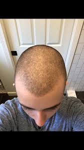 This hair is usually replaced with new finer hair. Receding Hairline At 16 Ftm Selfies