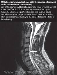 It is a condition involving changes to the bones, discs, and joints of the neck. Cervical Disc Disease And Difficulty Swallowing Cervicogenic Dysphagia Caring Medical Florida