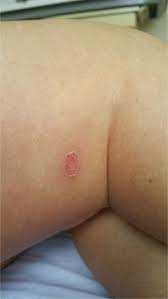 Image result for Rickettsialpox