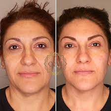 How many botox units are needed for laugh lines? What You Can Do About Smile Lines Qazi Cosmetic Clinic Irvine Ca