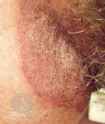 Image result for genital herpes