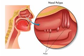 Your doctor will arrange for you to be seen following surgery to. Nasal Polyps When A Doctor May Recommend To Have Them Removed My Sinusitis
