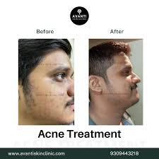 Stretch Marks Removal Near Me in Pune @ Cost Starting ₹30000/-