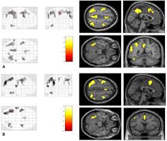What is visual snow, and does it go away? Localised Increase In Regional Cerebral Perfusion In Patients With Visual Snow Syndrome A Pseudo Continuous Arterial Spin Labelling Study Journal Of Neurology Neurosurgery Psychiatry