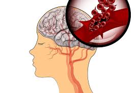 Diagnosis of cerebral veins and venous sinuses thrombosis maksimova m.yu., dubovitskaya yu.i., bryukhov v.v., krotenkovа m.v. Hospital General Innovara En Rehabilitacion Cerebral Tras Trombosis