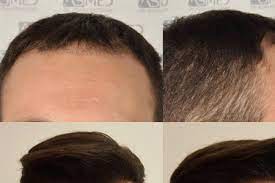 The oils themselves help the roots of the hair to strengthen and thus prevent further hair loss. Ayurvedic And Panchakarma Treatment For Hair Loss