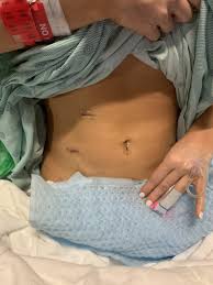 The second set of photos was of what i looked like after the removal of the uterus and the cervix. One Year Post Hysterectomy Mix Match Mama