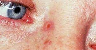 These are the best estimates we have at the moment. Skin Cancer Or Mole How To Tell Cbs News